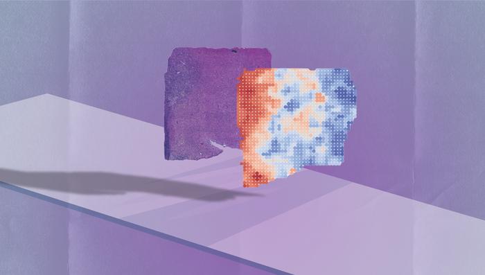 AI tool ‘sees’ cancer gene signatures in biopsy images