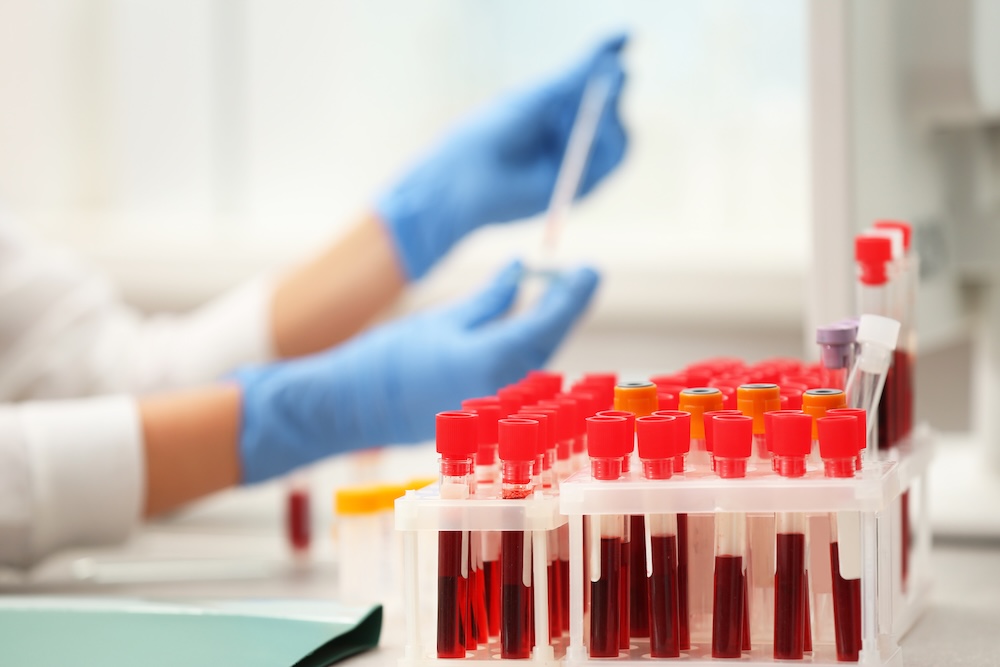 Bristol uni spinout raises £700k for vascular disease blood test