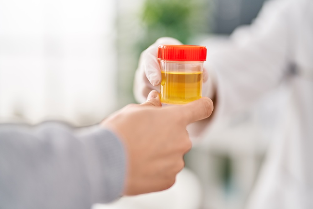 At-home urine test detects 92% of bladder cancer cases in NHS trial